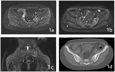 CT-guided joint cavity release for postpartum sacroiliac joint pain management: an evaluation of its efficacy, safety, and clinical outcomes